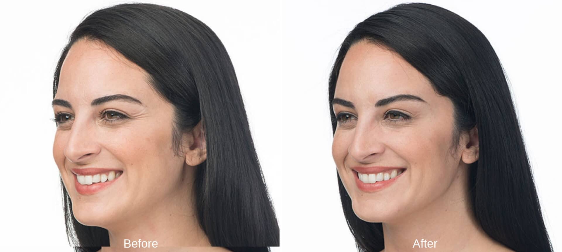 Experts Reveal the Neck-Sculpting Treatments That Most Patients Don't Know  About - NewBeauty