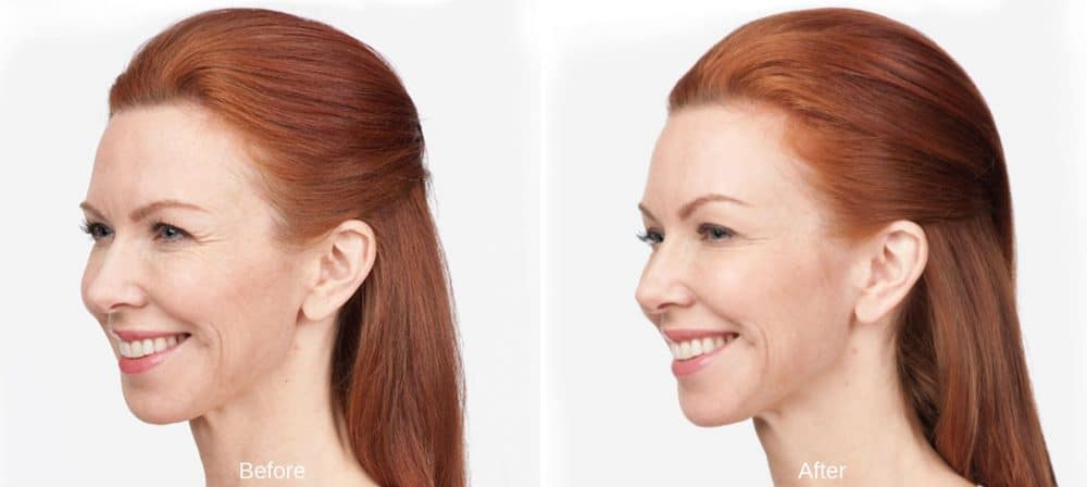 Botox Before and After Westport, CT New Beauty Wellness Botox Before and After Westport, CT New Beauty Wellness
