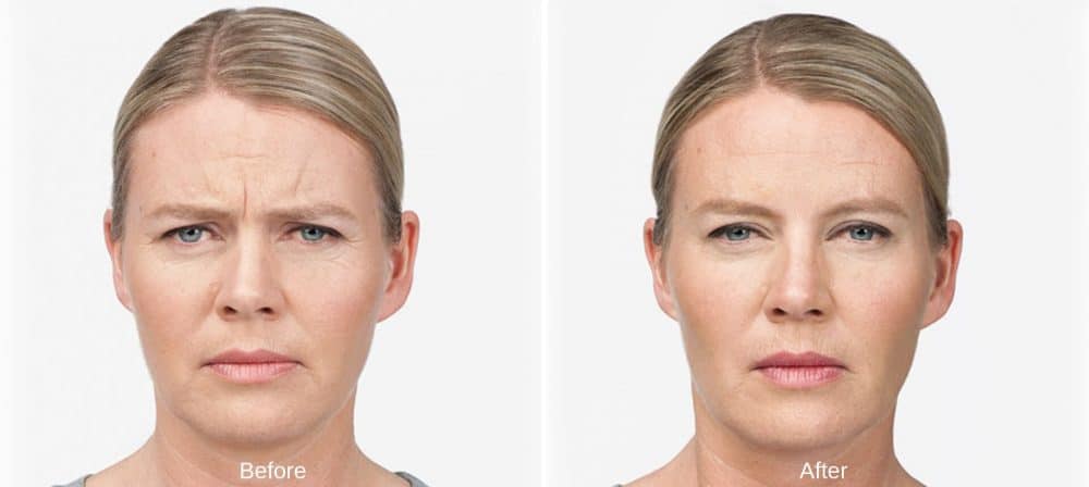 Botox Before and After Westport, CT New Beauty Wellness