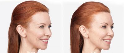 botox before and after