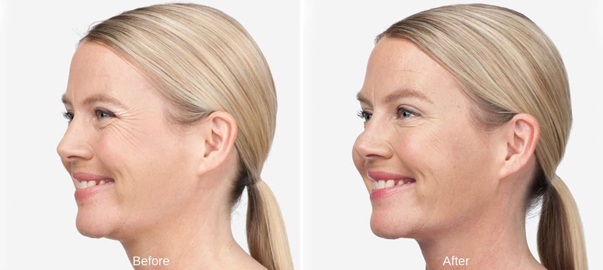 new-beauty-wellness-botox-before-after-9