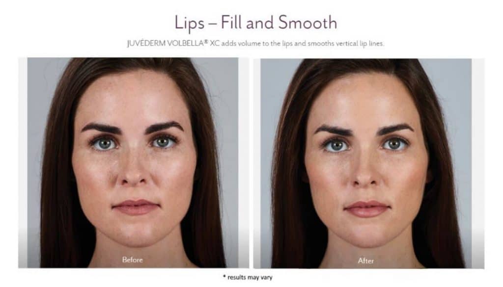 Lip Fillers With Juvéderm 