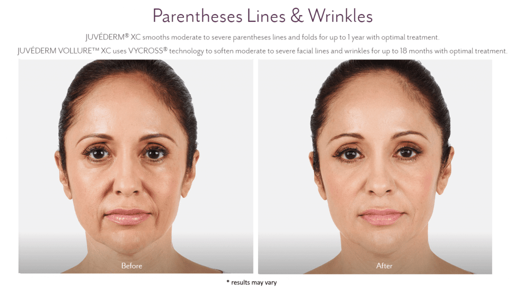 Imágenes de antes y después de Juvederm / Juvederm Westport CT The