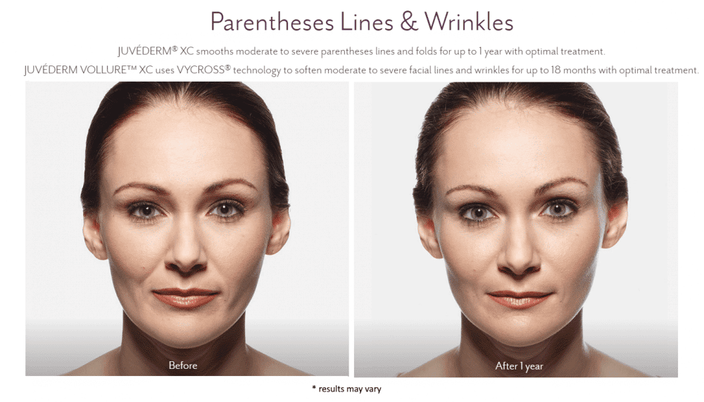 Juvederm Before and After Pictures Juvederm Westport CT