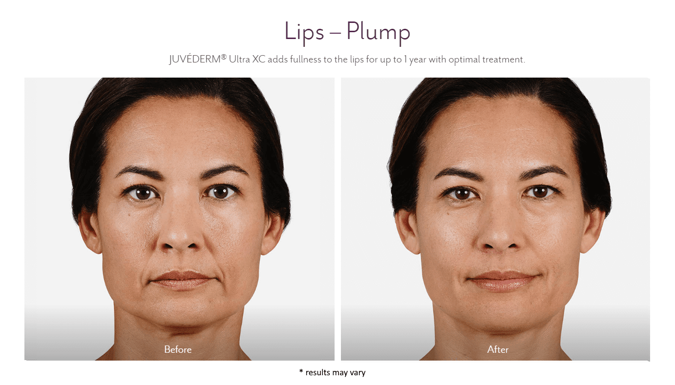 Woman's before and after juvederm dermal fillers.