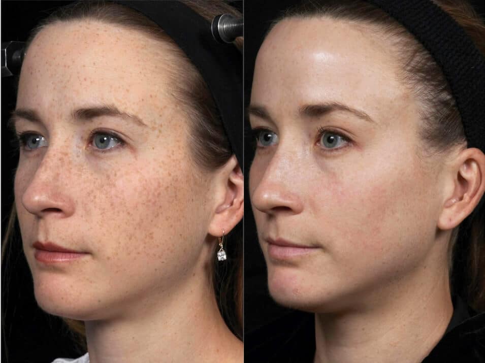 Laser Facial Treatment | Before And After