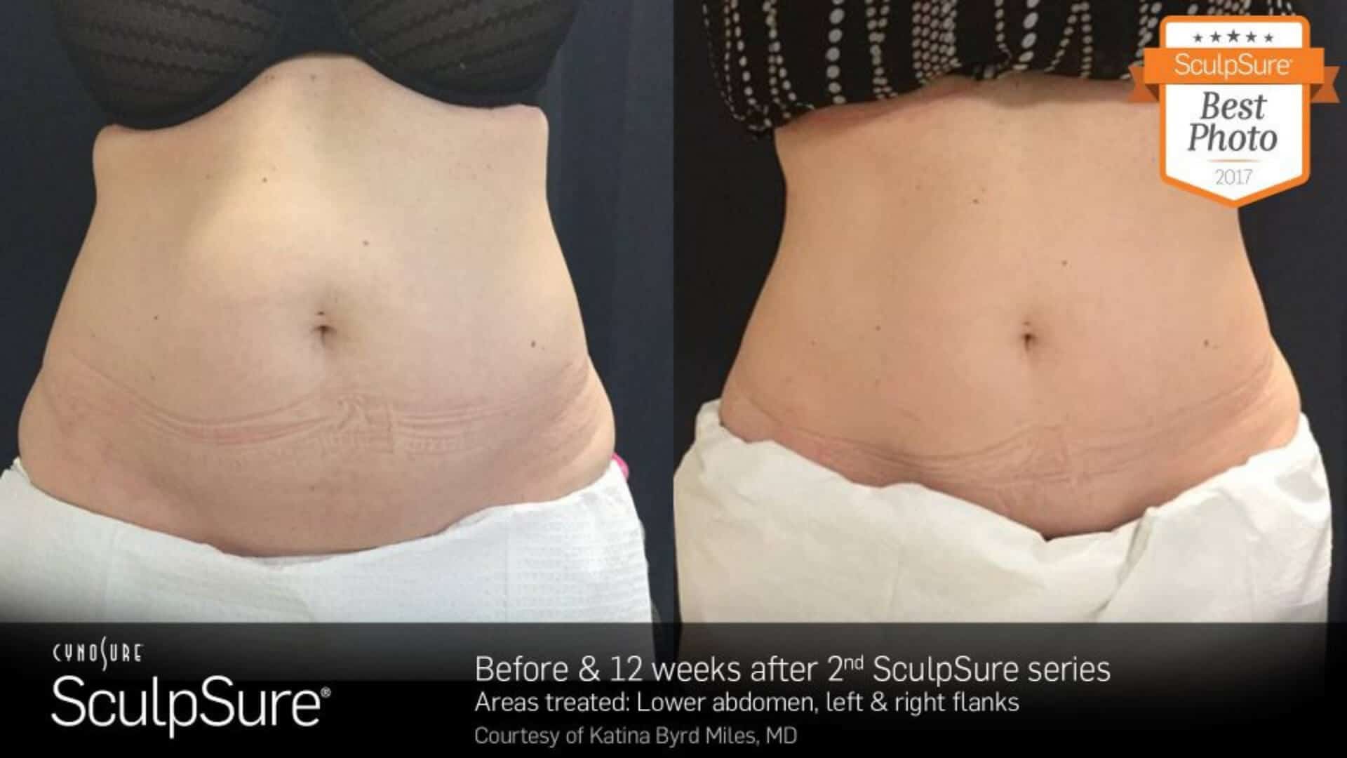 sculpsure-before-and-after-11