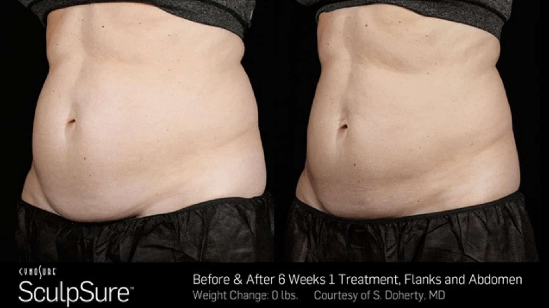 sculpsure-before-and-after-12