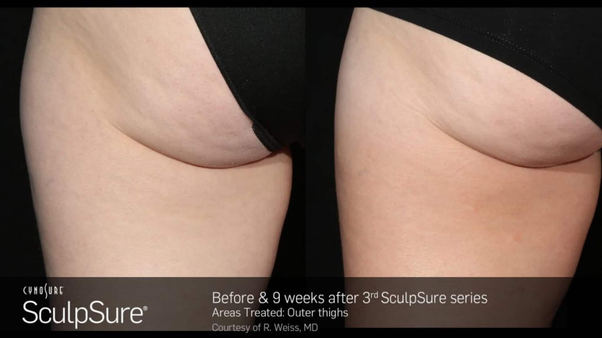 sculpsure-before-and-after-7