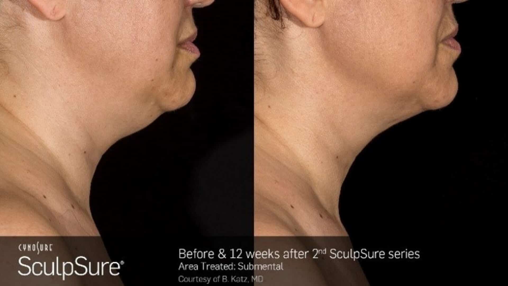 sculpsure-before-and-after-8