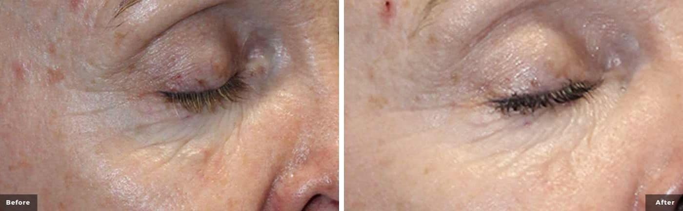 rf-microneedling-before-and-after-1