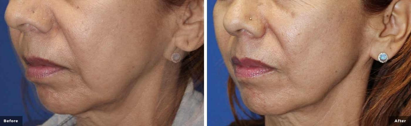 rf-microneedling-before-and-after-2