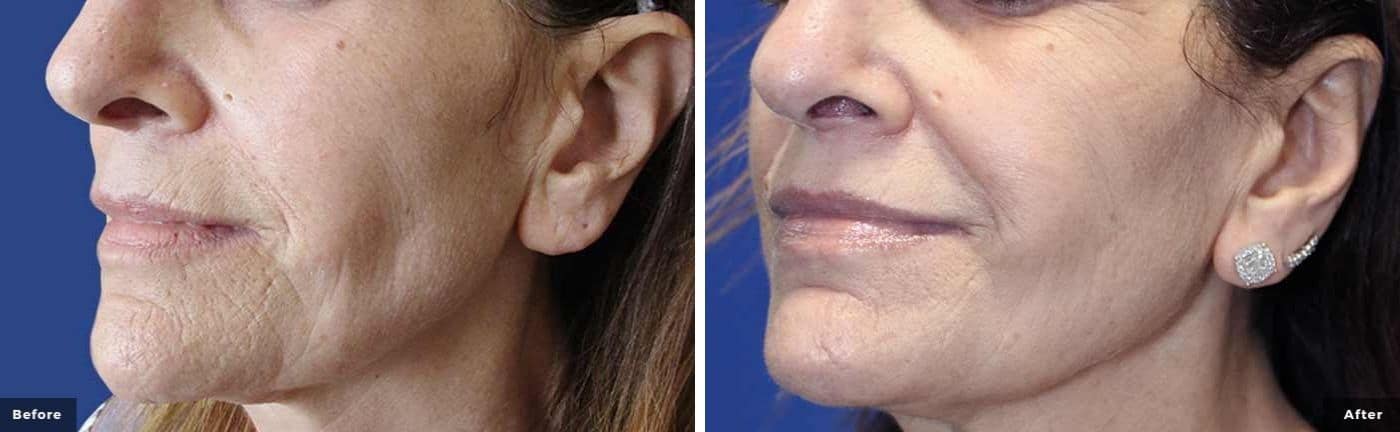 rf-microneedling-before-and-after-3