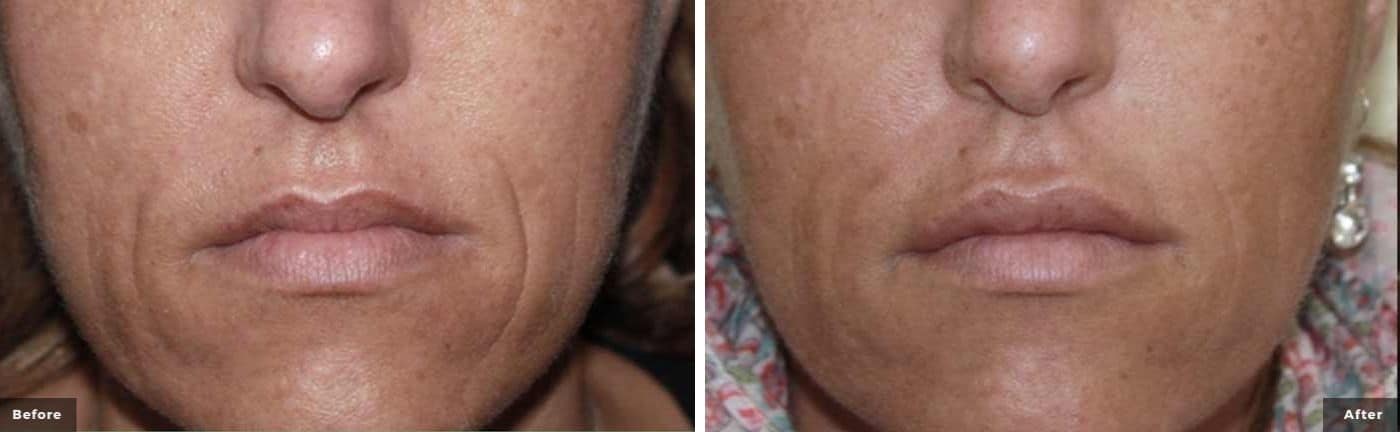 rf-microneedling-before-and-after-4