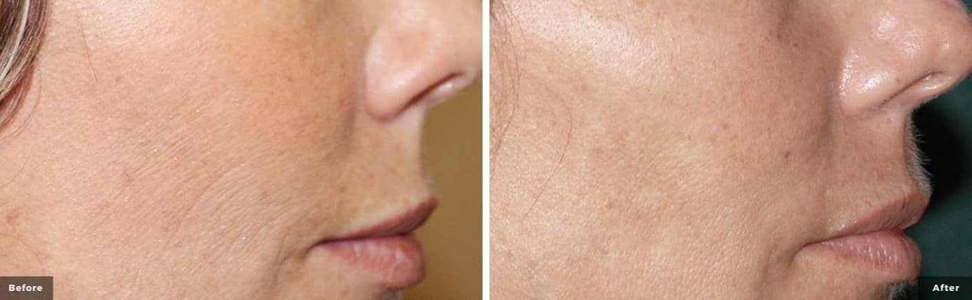 rf-microneedling-before-and-after-5