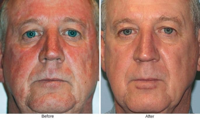 bbl-photofacial-before-and-after-in-westport-ct-1