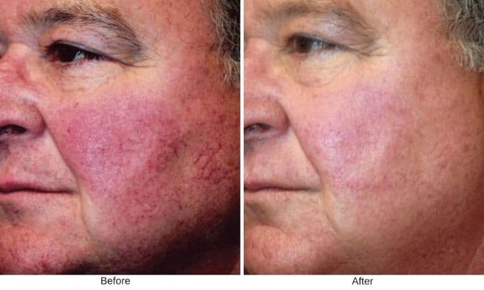 bbl-photofacial-before-and-after-in-westport-ct-3