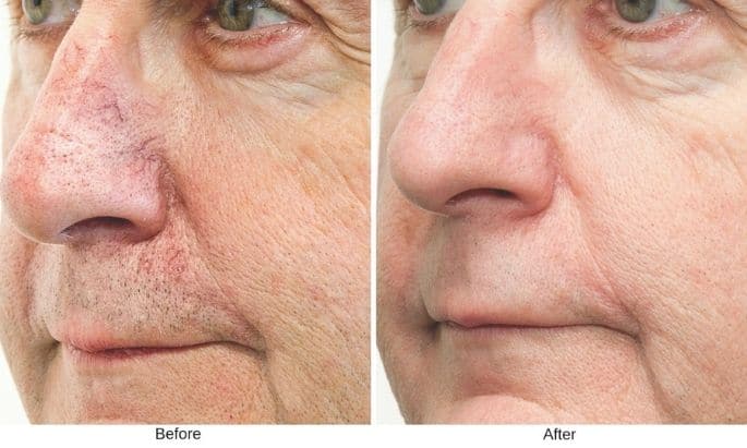 bbl-photofacial-before-and-after-in-westport-ct-4