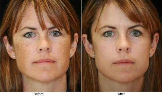 bbl-photofacial-before-and-after-in-westport-ct-5