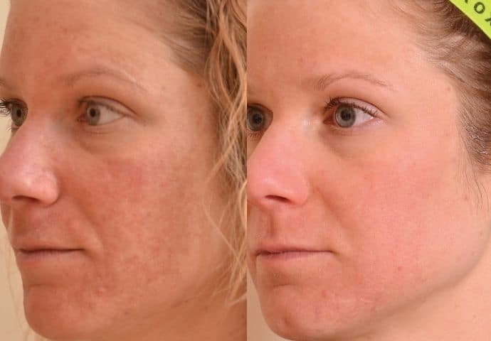 halo-laser-treatment-before-and-after-2
