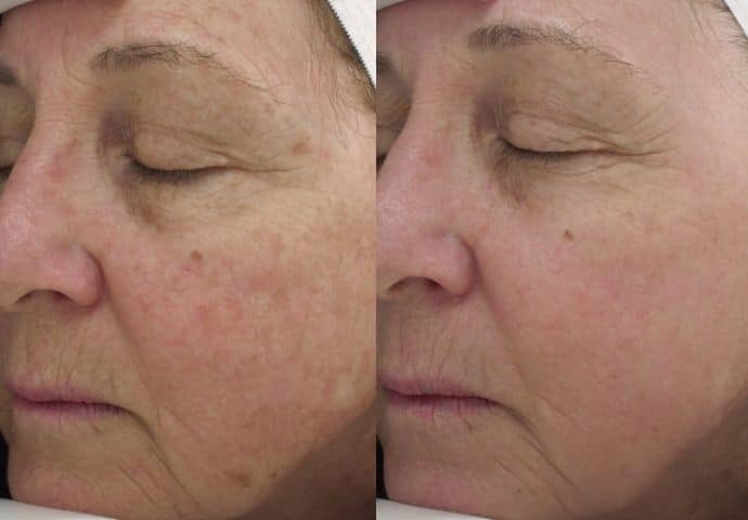 halo-laser-treatment-before-and-after-3
