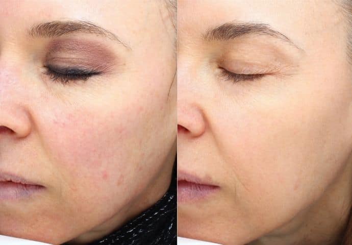 halo-laser-treatment-before-and-after-4