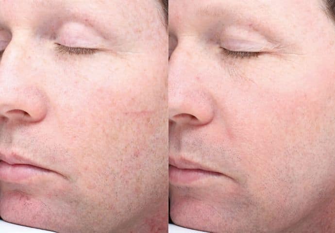 halo-laser-treatment-before-and-after-5