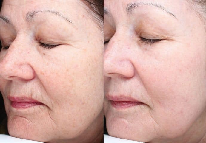 halo-laser-treatment-before-and-after-6