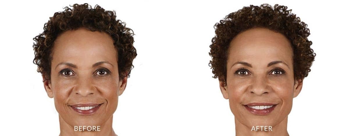 juvederm-before-and-after-image-3