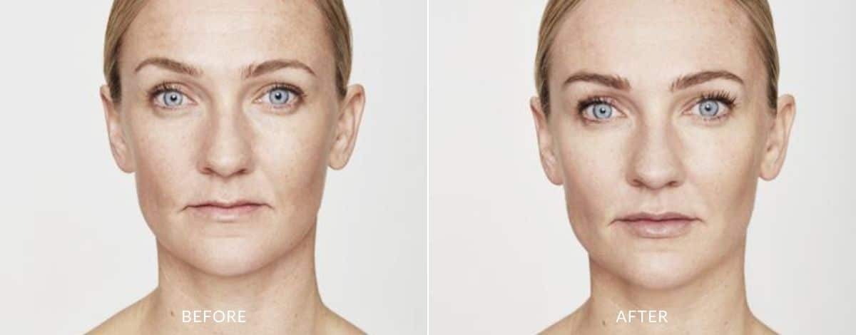 restylane-before-and-after-image-1