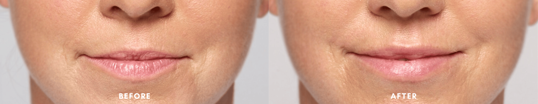 lip-fillers-restylane-before-and-after-3