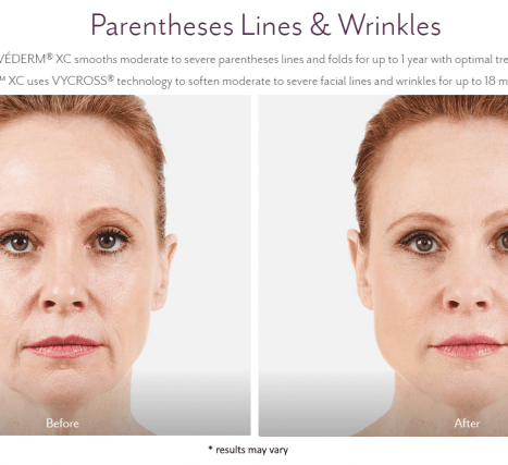 Juvederm Before and After Pictures | Juvederm Westport CT